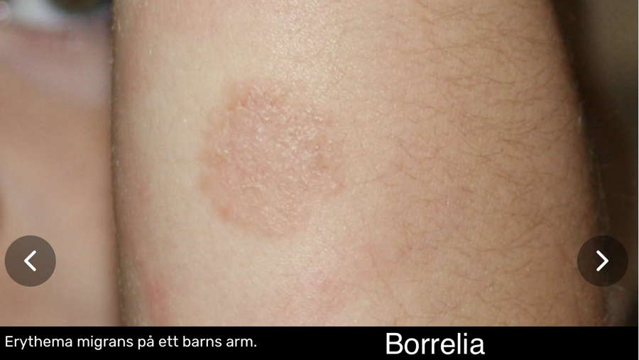 Bild på borrelia